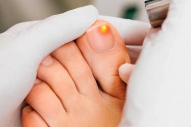 LASER-FUNGUS-REMOVAL