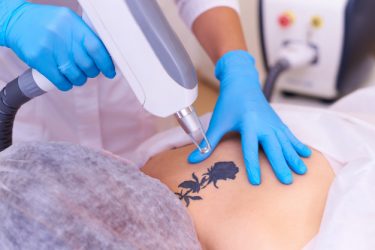 laser-tattoo-removal-cosmetology-clinic_83055-1383