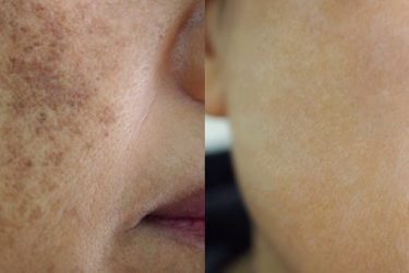 pigmentation-laser-treatment-before-after-1024x394