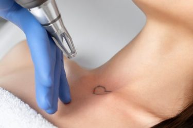 woman-tattoo-removal